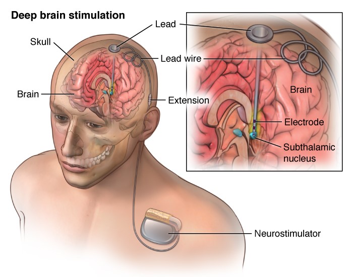 Deep Brain stimulation - Two small electrodes are placed on either side of a specific brain structure